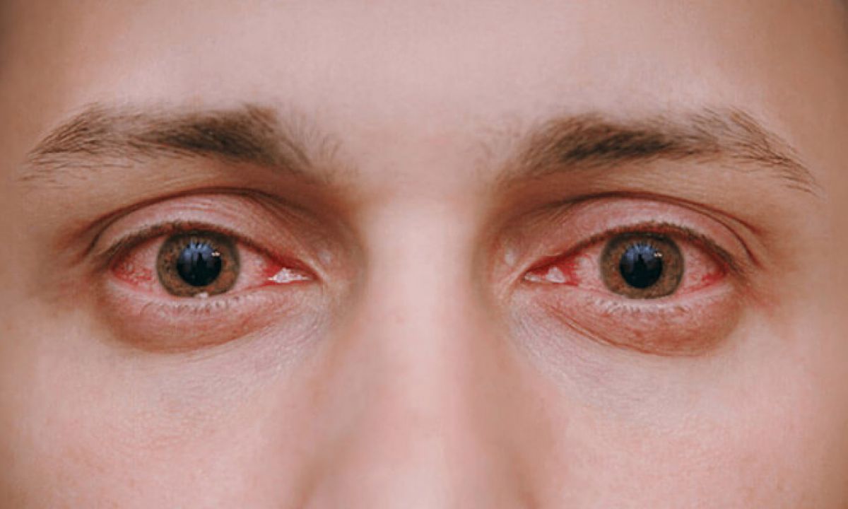 20 Symptoms That Can Indicate Eye Problems